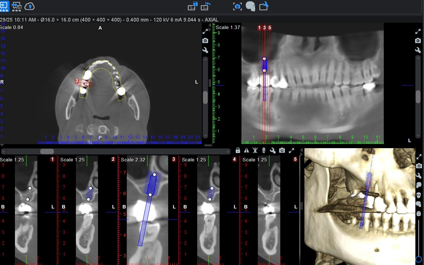 Imagine 3D CBCT pentru planificarea implantului dentar