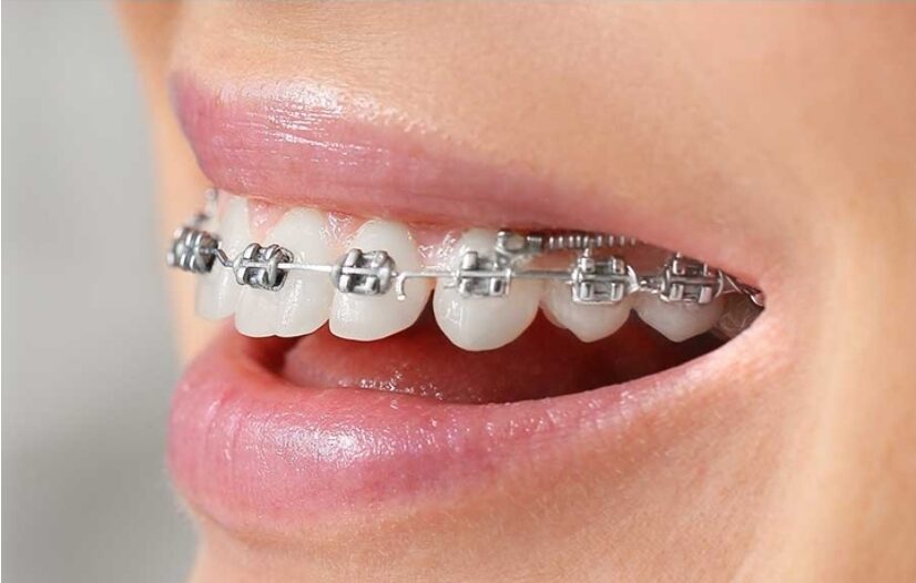 Aparat dentar — ortodonție la Dent SmartElit Clinic